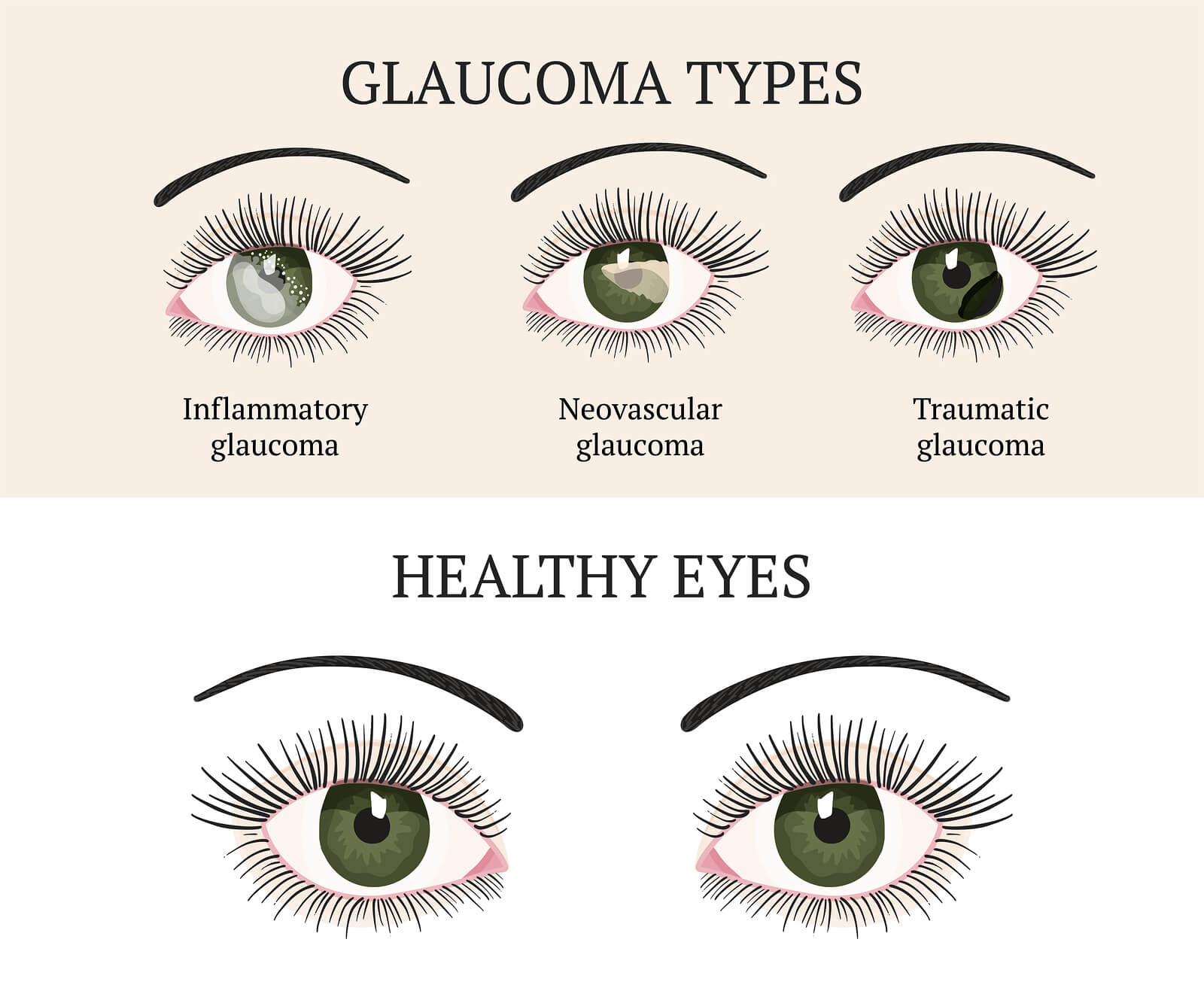 Glaucoma Symptoms