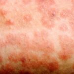 The current image has no alternative text. The file name is: Measles.jpg