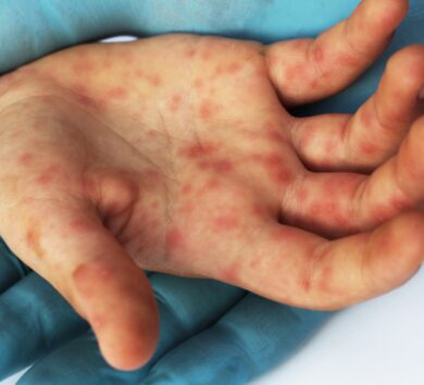 Hand-food-and-mouth disease triggers seasonal alert for Westmoreland
